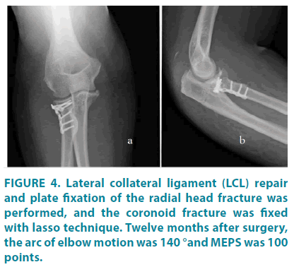 clinical-practice-Lateral-collateral-ligament