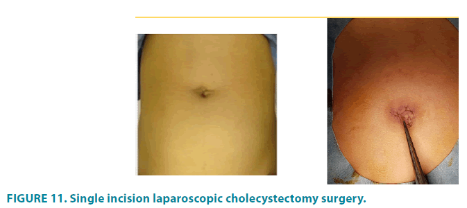 clinical-practice-Single-incision