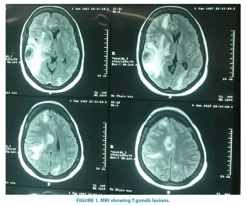 clinical-practice-T-gondii-lesions