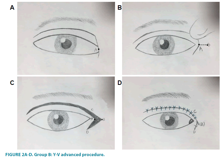 clinical-practice-Y-V-advanced-procedure