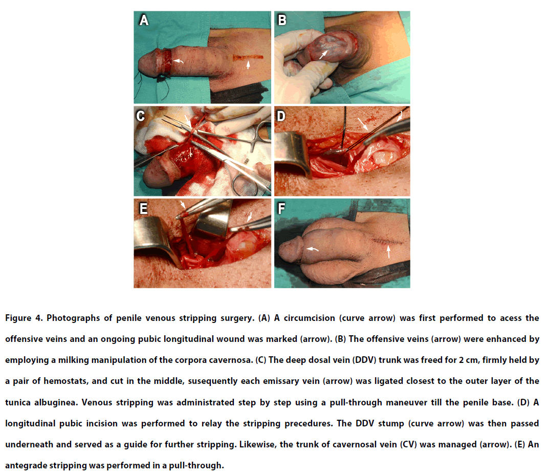 clinical-practice-antegrade-stripping