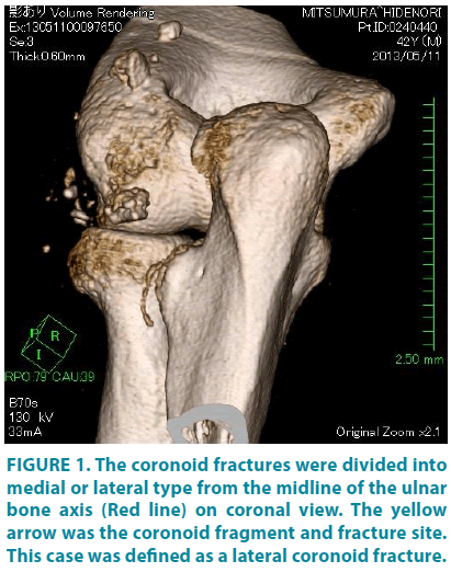 clinical-practice-coronoid-fractures