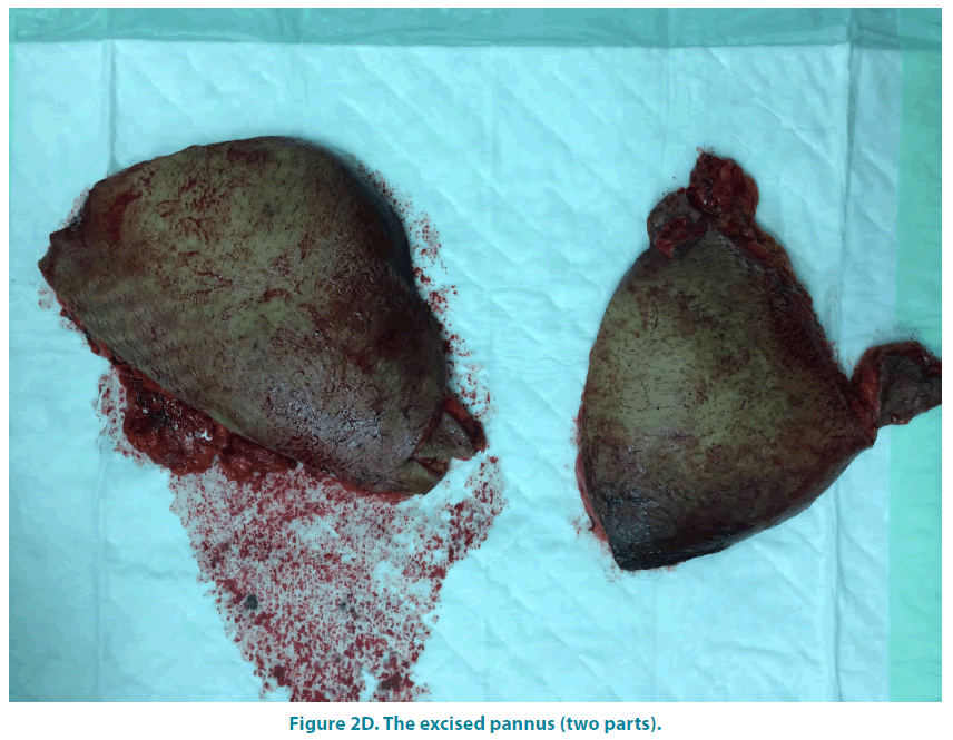 clinical-practice-excised-pannus