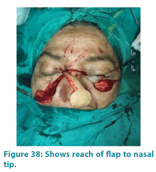 clinical-practice-flap-nasal