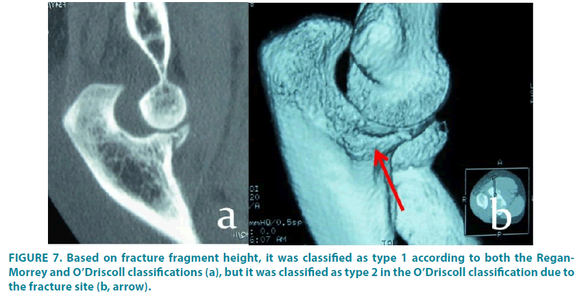 clinical-practice-fracture-fragment