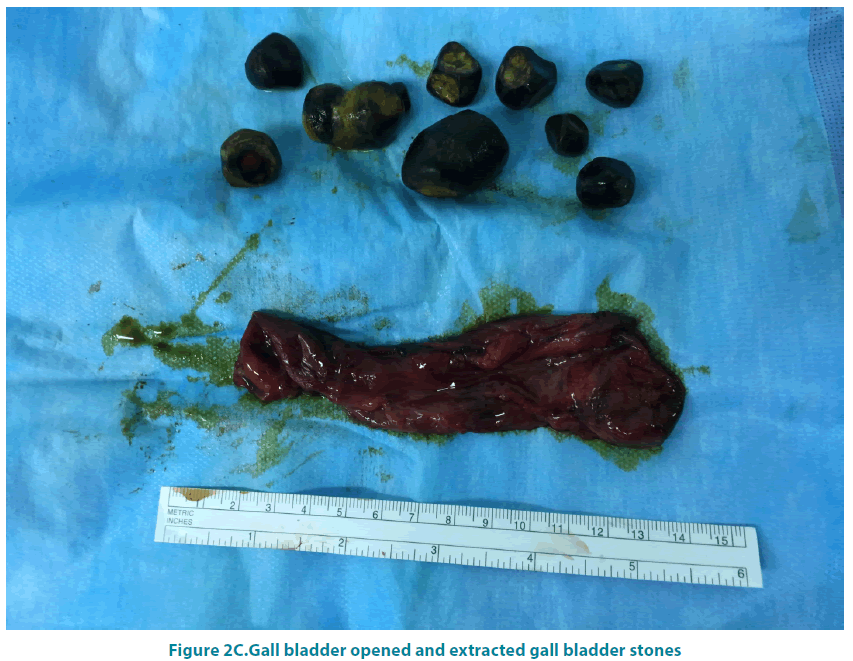 clinical-practice-gall-bladder-stones