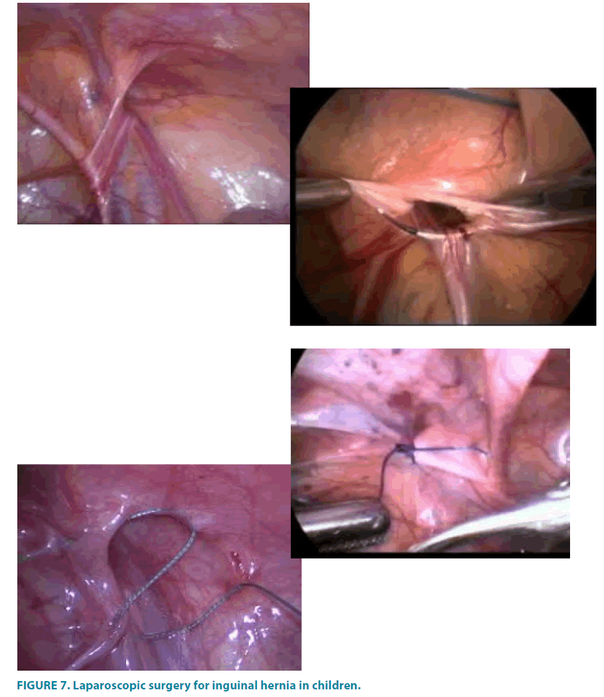 clinical-practice-inguinal-hernia