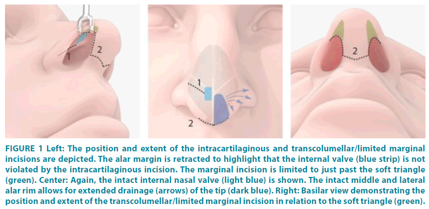 clinical-practice-intracartilaginous