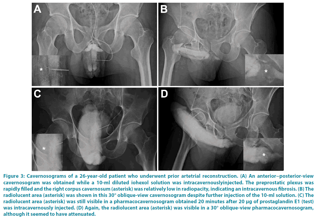 clinical-practice-intracavernouslyinjected