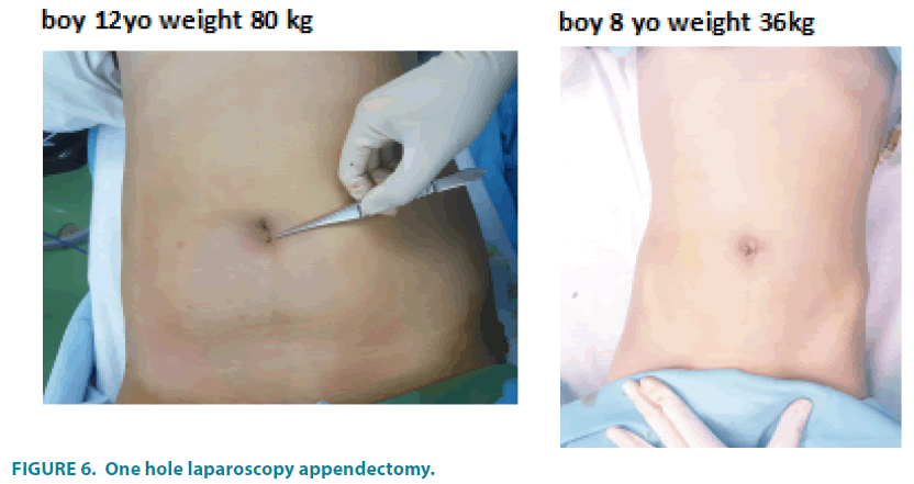 clinical-practice-laparoscopy-appendectomy