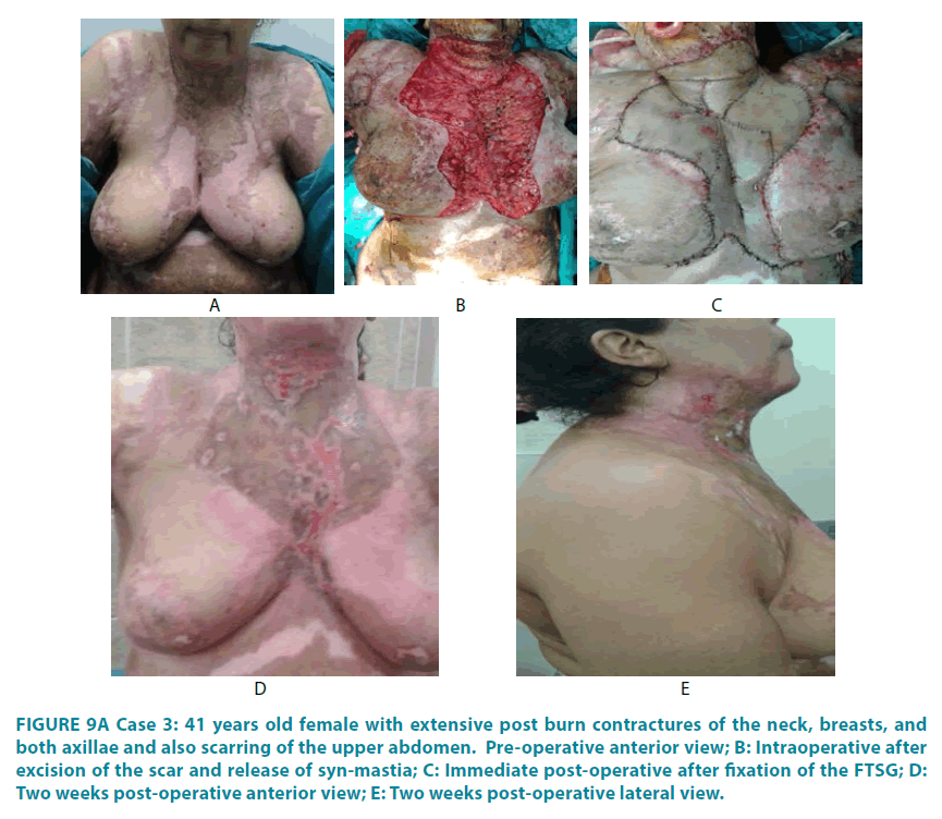 clinical-practice-post-burn-contractures