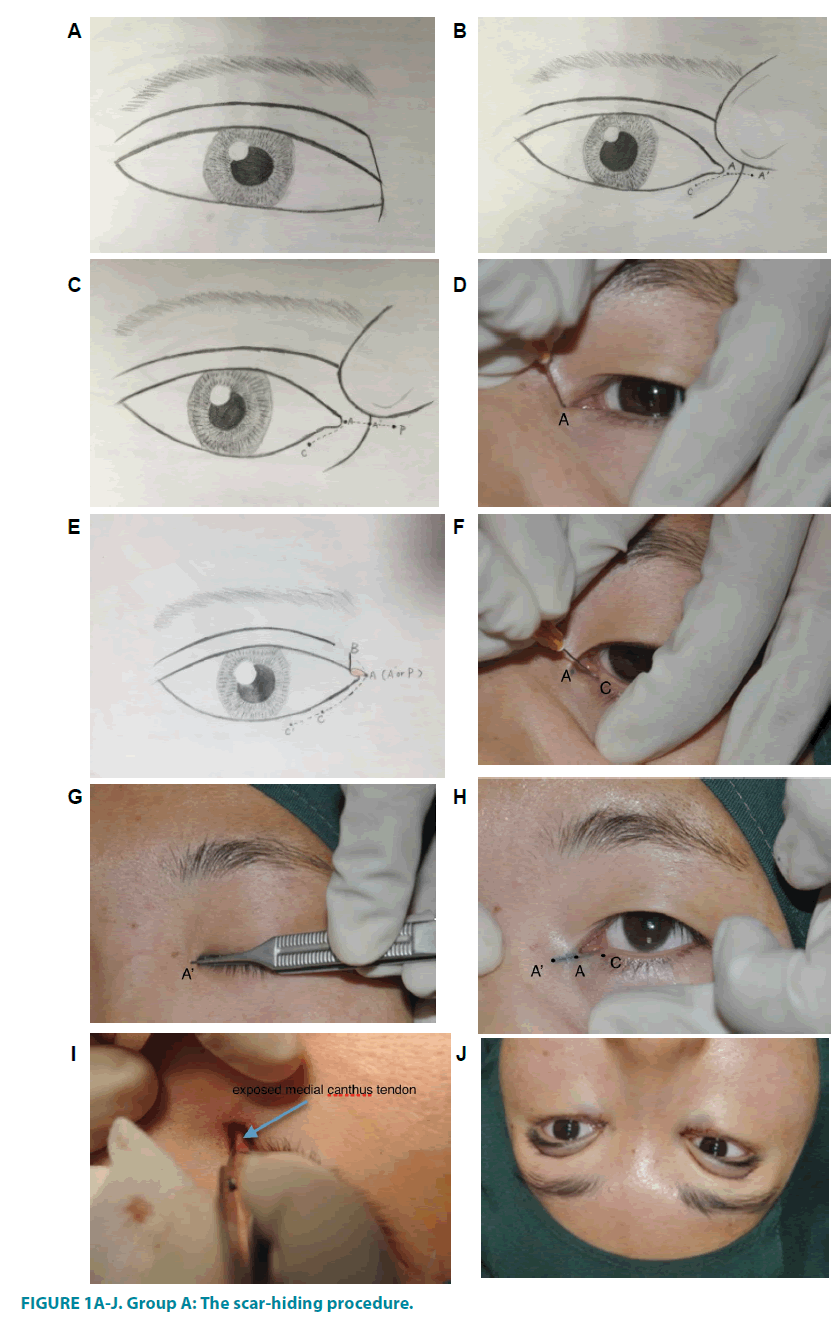 clinical-practice-scar-hiding-procedure