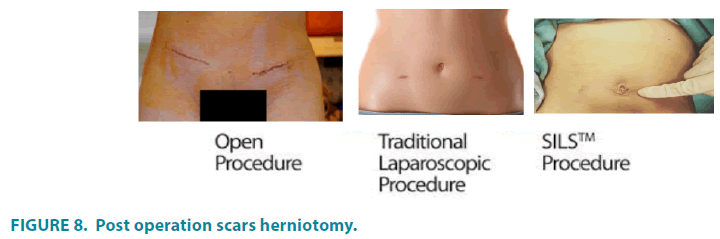 clinical-practice-scars-herniotomy