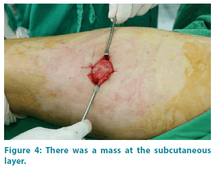 clinical-practice-subcutaneous-layer