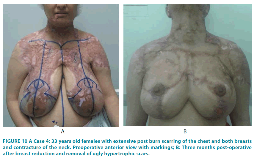 clinical-practice-ugly-hypertrophic-scars