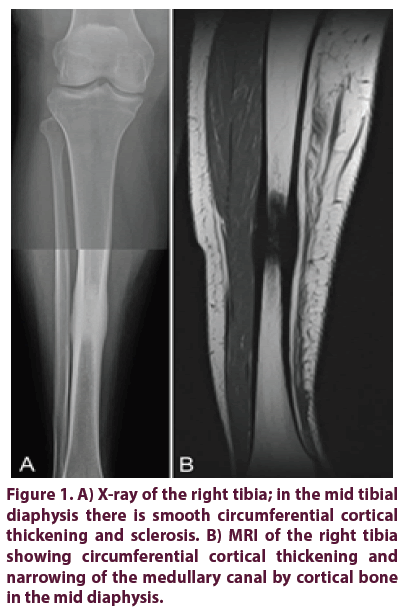 clinical-rheumatology-circumferential-cortical