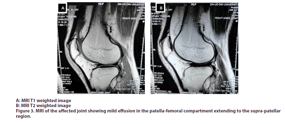 clinical-rheumatology-effusion