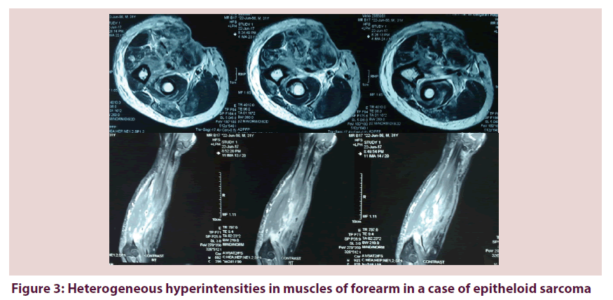 clinical-rheumatology-epitheloid-sarcoma