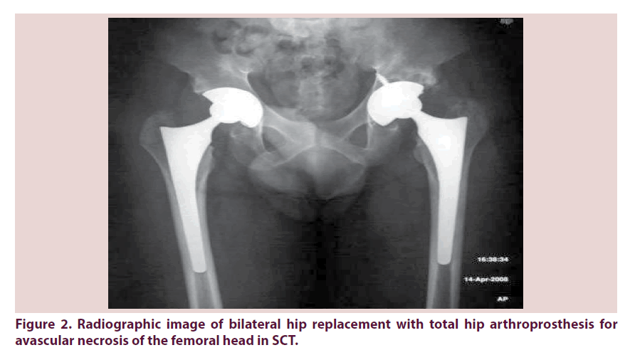 clinical-rheumatology-femoral-head