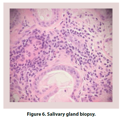 clinical-rheumatology-gland-biopsy