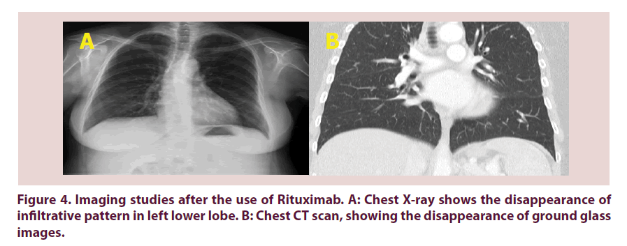 clinical-rheumatology-infiltrative-pattern