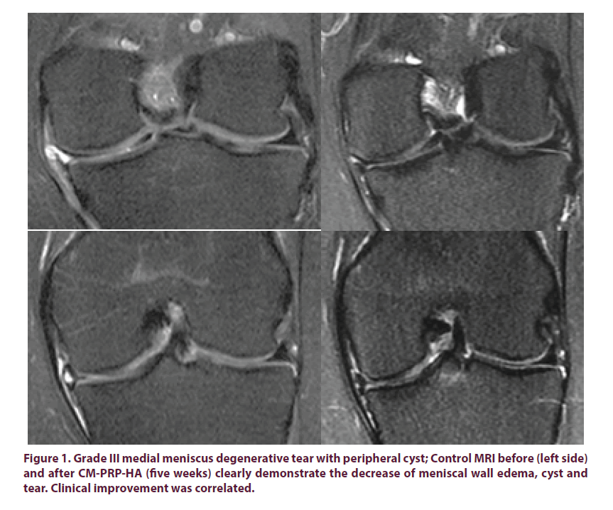 clinical-rheumatology-medial-meniscus