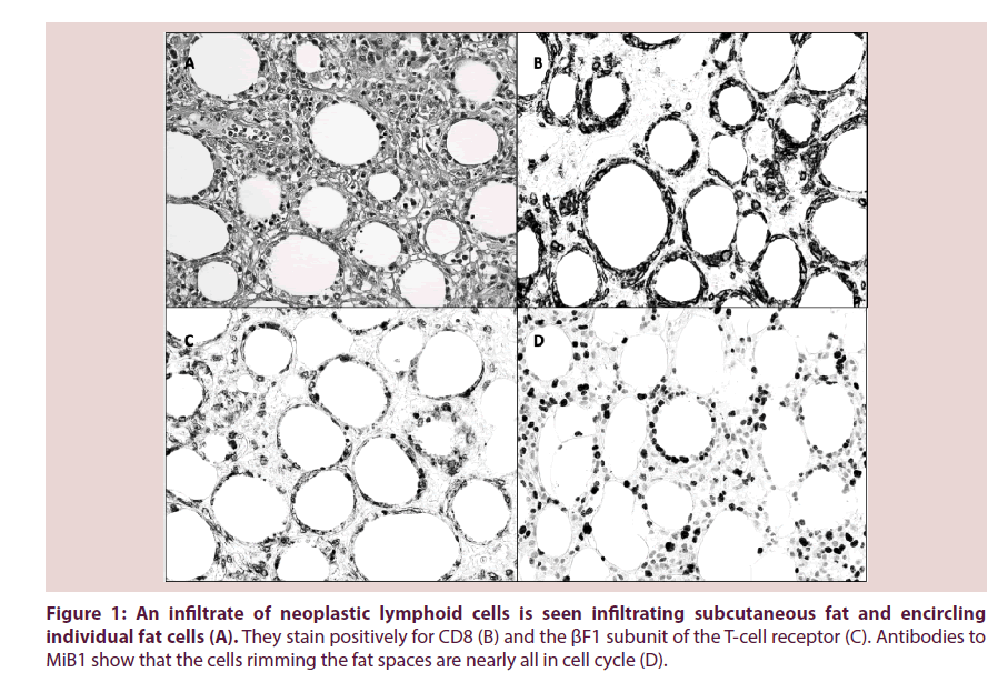 clinical-rheumatology-neoplastic-lymphoid