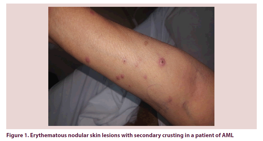 clinical-rheumatology-nodular-skin