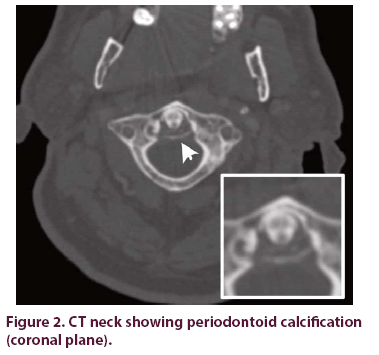 clinical-rheumatology-periodontoid