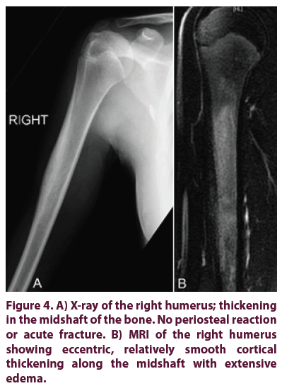 clinical-rheumatology-periosteal-reaction