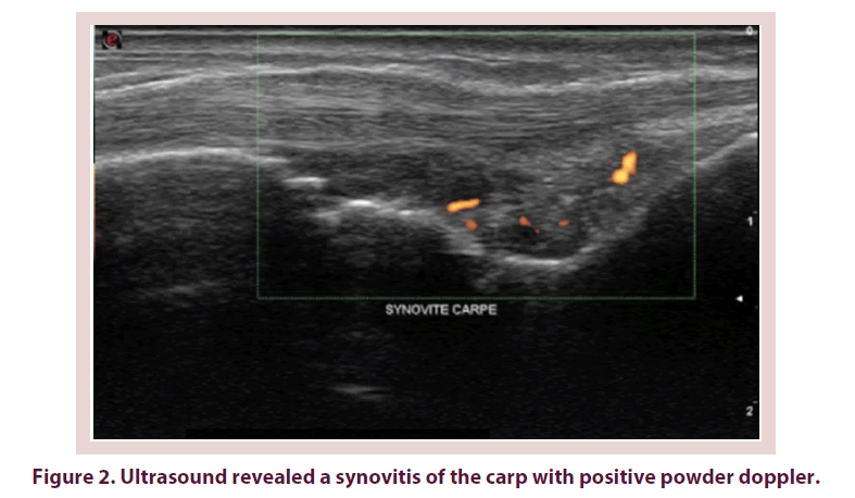 clinical-rheumatology-powder-doppler