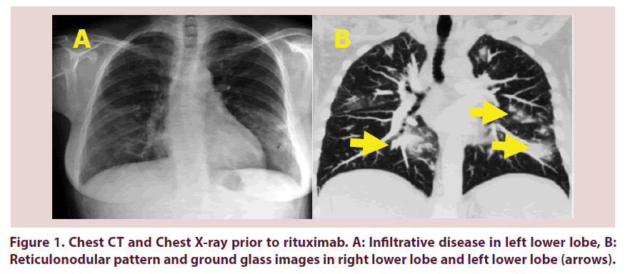 clinical-rheumatology-prior-rituximab