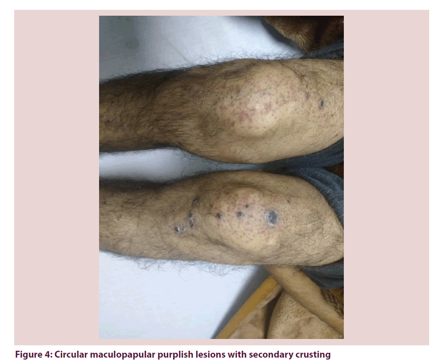 clinical-rheumatology-purplish-lesions