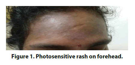 clinical-rheumatology-rash-forehead