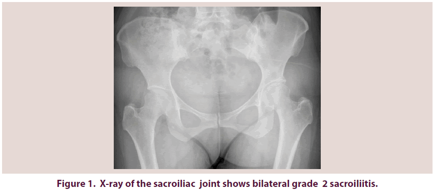 clinical-rheumatology-sacroiliac-joint