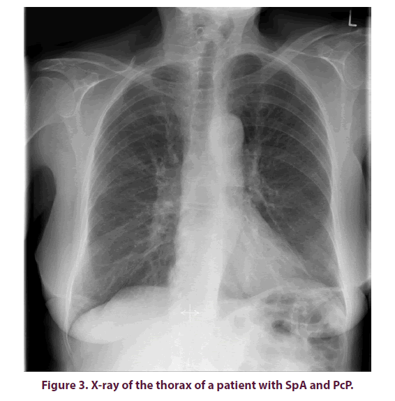clinical-rheumatology-thorax-patient
