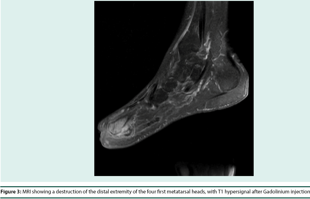 diabetes-management-MRI-showing-destruction