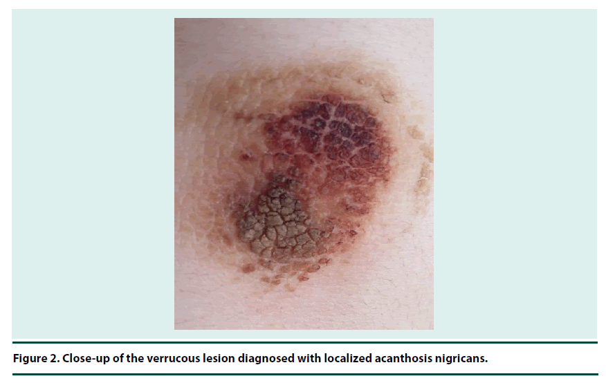 diabetes-management-acanthosis-nigricans