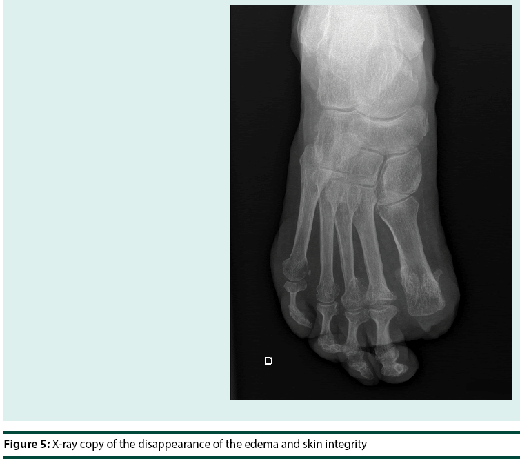 diabetes-management-edema-skin-integrity