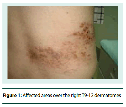 diabetes-management-right-T9-12-dermatomes