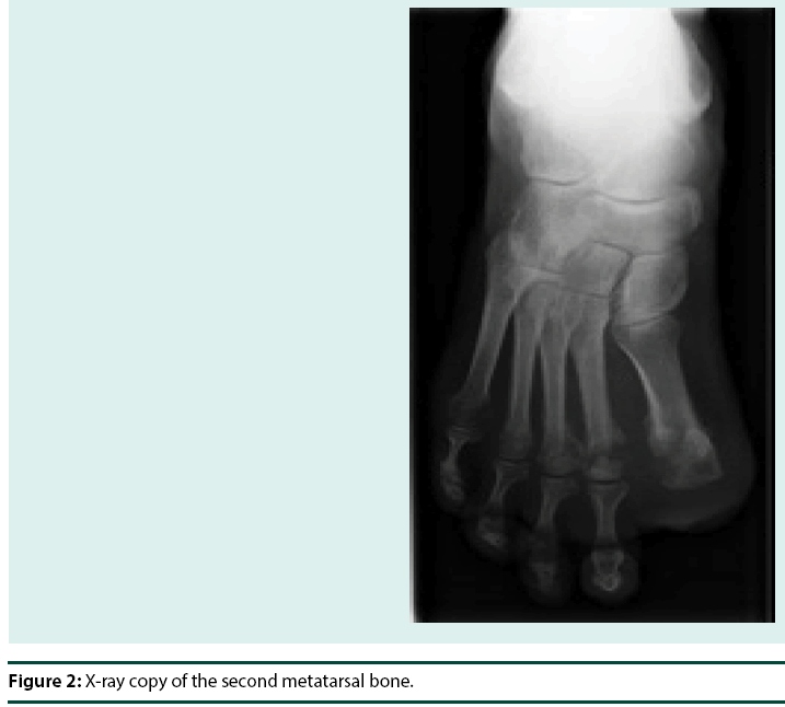 diabetes-management-second-metatarsal-bone