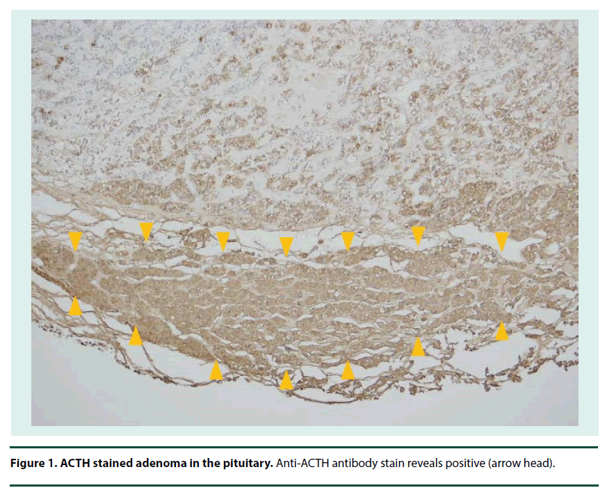 diabetes-management-stained-adenoma