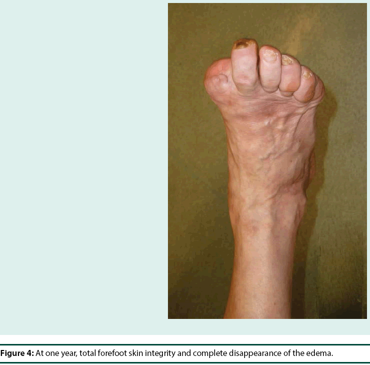 diabetes-management-total-forefoot-skin-integrity
