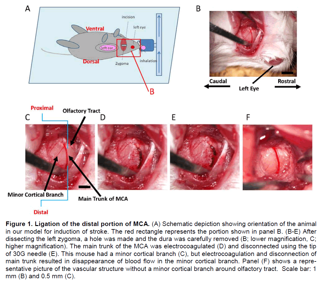 experimental-stroke-Schematic-depiction