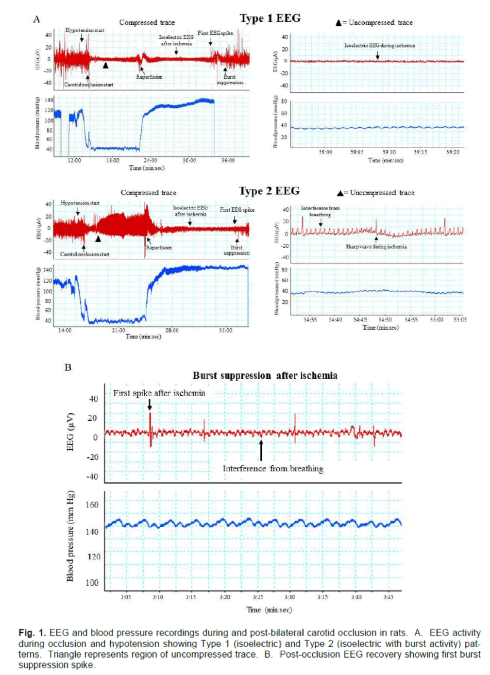 experimental-stroke-pressure-recordings