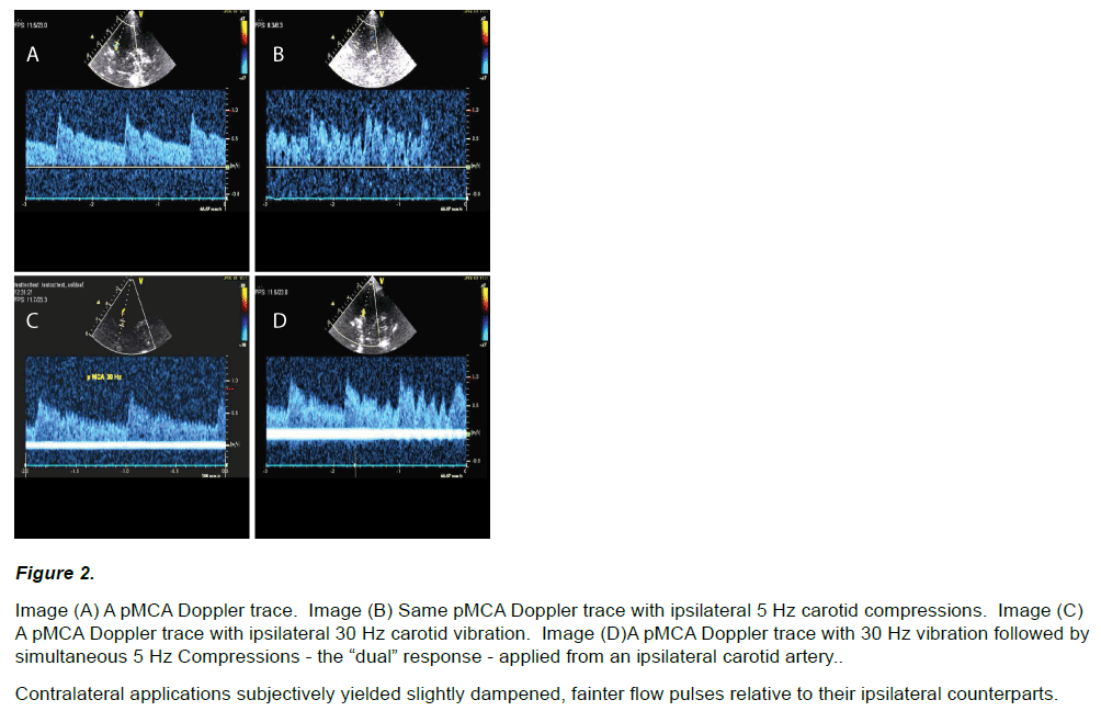 experimental-stroke-translational-medicine-Doppler-trace