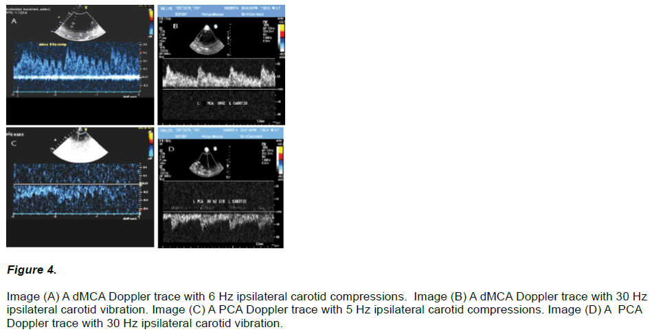 experimental-stroke-translational-medicine-carotid-compressions