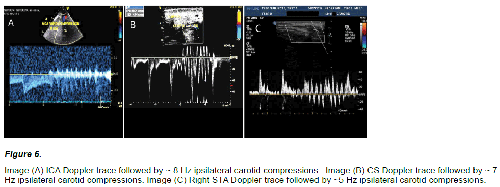 experimental-stroke-translational-medicine-ipsilateral-carotid