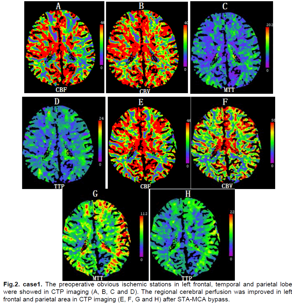 experimental-stroke-translational-medicine-preoperative-obvious