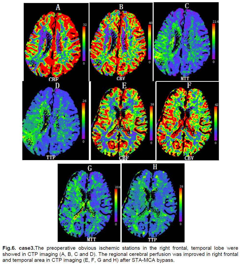 experimental-stroke-translational-medicine-temporal-lobe